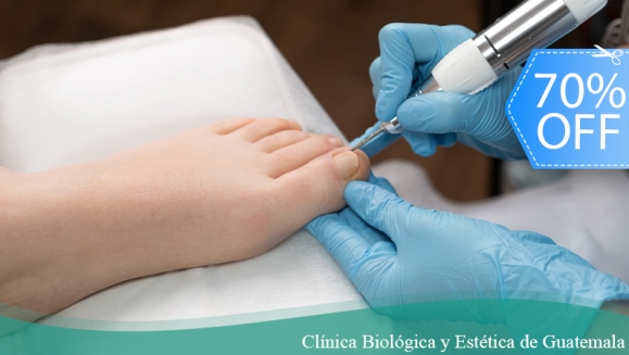 [Image: ¡Paga Q75 en lugar de Q250 por Pedicure Clínico en Seco que Incluye: Limpieza de Canales, Exfoliación, Recorte de Uñas, Eliminación de Callosidades, Limado, Detección Temprana de Enfermedades de la Piel o Uñas y Más!m]
