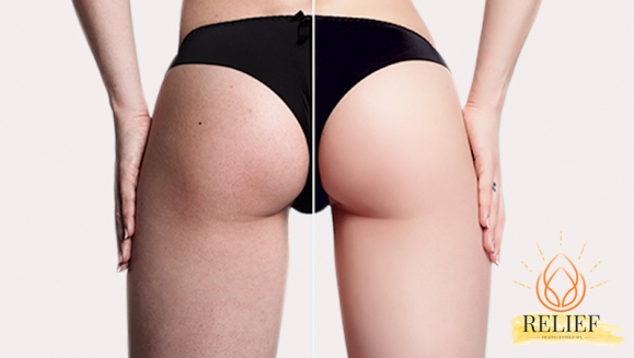 [Image: ¡Paga Q199 en Vez de Q3,000 por 55 Tratamientos de Reducción, Tonificación, Moldeo y Anticelulitis: 6 Radiofrecuencias + 6 Vacumterapias + 6 Body Shaper + 6 Copas Suecas + 7 Carboxiterapias + 6 Crio TX + 6 Reafirmantes + 6 Rodillos Lisos y Más!m]