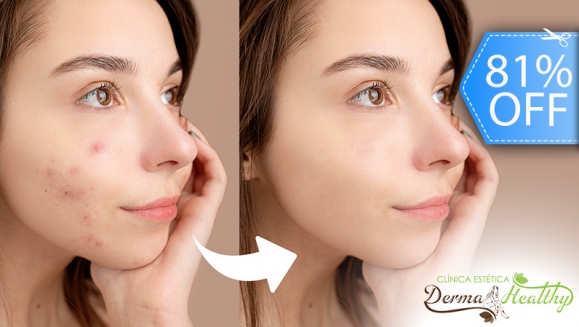 [Image: ¡Paga Q169 en Lugar de Q900 por Terapia Clínica Anti Acné: Luz Pulsada en 2 Puntos del Rostro + Alta Frecuencia + Exfoliación Suave + Extracción de Impurezas + Mascarilla Combinada Descongestiva y Desinfectante!m]