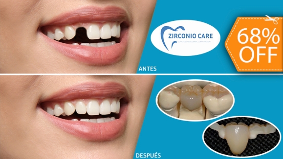 [Image: ¡Pre-Venta! ¡Paga $85 en Lugar de $265 por Pre-Venta 1 Pieza Dental de Zirconio, Resina y Porcelana (Sin Metales) + Limpieza Dental con Ultrasonido + Evaluación de Cordales!m]