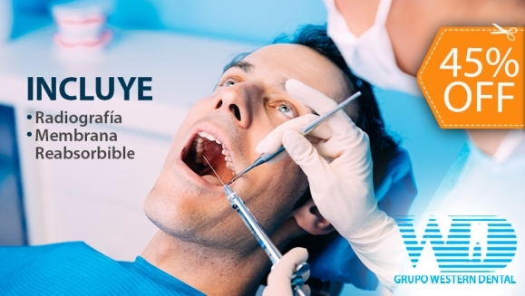 [Image: ¡Paga $150 en Lugar de $275 por Cirugía o Extracción de 1 Cordal + Radiografía + Membrana Reabsorbible + Antiinflamatorio Inyectado Pre Quirúrgico + Consulta de Evaluación + Limpieza con Ultrasonido + Consulta Ortodóntica + Consulta Postoperatoria!m]