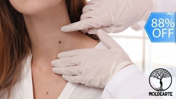 [Image: ¡Paga Q75 en Lugar de Q650 por Cauterización Láser de Hasta 20 Cabezas de Vena, 4 Lunares o 4 Verrugas (de hasta 5 mm) + Evaluación Médica!m]