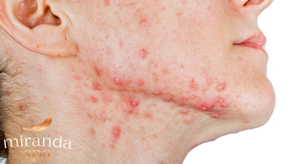 [Image: ¡Paga Q499 en Lugar de Q2,500 por Tratamiento VIP Antiacné con: Dermapen + Microdermoabrasión + Cauterización + Mascarilla Purificante + Oxigenación + Limpieza!m]