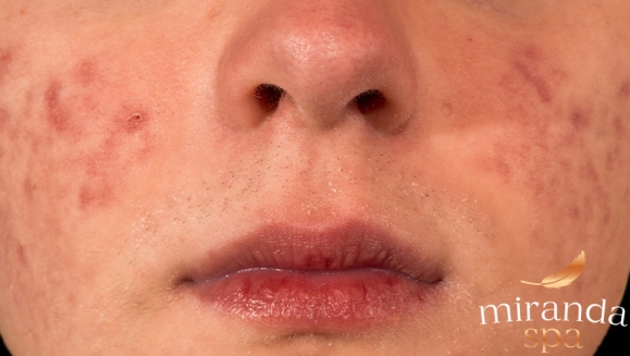 [Image: ¡Paga Q499 en Lugar de Q2,500 por Tratamiento VIP Antiacné con: Dermapen + Microdermoabrasión + Cauterización + Mascarilla Purificante + Oxigenación + Limpieza!m]
