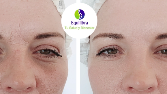 [Image: ¡Paga Q1,299 en Lugar de Q20,000 por Armonización Facial con Tratamiento Personalizado que Incluye: Bioestimulación + Aplicación de Ácido Hialurónico + Rellenos Faciales + Aparatología Médica + Aplicación de Botox + Evaluación!m]