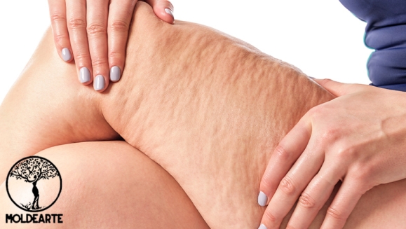 [Image: ¡Paga Q199 en Lugar de Q1,200 por 4 Sesiones para Combatir Celulitis en Piernas, Brazos o Espalda con 4 Ultracavitaciones + 4 Lipolisis + 4 Radiofrecuencias Hexapolares + 4 Carboxiterapias + 4 Vacumterapias + 4 Masajes Reductores y Más!m]