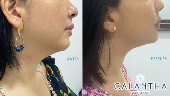 [Image: ¡Paga $99 en Lugar de $450 por 3 Sesiones para Reducción de Papada con: 3 Infiltraciones Múltiples con Cóctel de Enzimas + 3 Radiofrecuencias + 3 Masajes Linfáticos + Evaluación Médica + Membresía Anual!m]