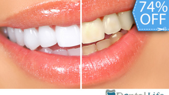 [Image: ¡Paga Q395 en lugar de Q1,500 por Blanqueamiento Dental Láser + Limpieza y Pulido Dental con Profilaxis + Eliminación de Sarro con Ultrasonido + Aplicación Tópica de Flúor + Examen Diagnóstico en Dental Life!m]