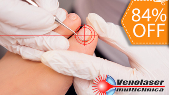 [Image: ¡No esperes más y despídete YA de los Hongos! ¡Paga $39 en vez de $250 por Tratamiento Láser de 1 Sesión para Hongos en las Uñas en Venolaser!m]