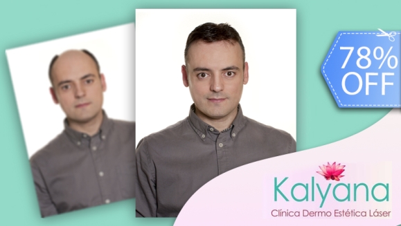 [Image: ¡Libérate YA de la Calvicie! ¡Paga Q699 en vez de Q3,125 por Paquete para Alopecia que incluye: 1 Sesión de Plasma Rico en Plaquetas + 2 Sesiones de Carboxiterapia + 1 Sesión de Luz LED roja en Clínica Dermatológica Kalyana!m]