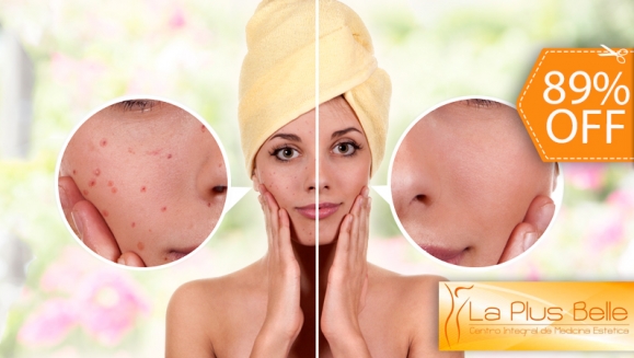 [Image: ¡Paga $49 en vez de $440 por Paquete Facial para Acné, Cicatrices y Manchas que Incluye: 2 Sesiones de Láser Facial + 2 Microdermoabrasiones + 2 Limpiezas Profundas en La Plusbelle!m]