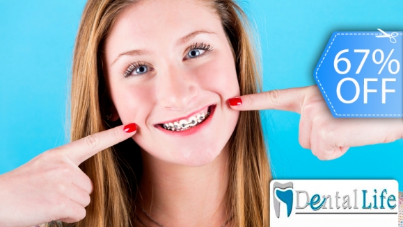 [Image: ¡Paga Q599 en vez de Q1,800 por Paquete de Ortodoncia que Incluye: Colocación de Brackets Metálicos (Superiores e Inferiores) + Evaluación y Diagnóstico Clínico + Limpieza Completa + Fotografías y Modelo de Estudio en Dental Life!m]