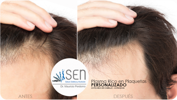 [Image: ¡Paga $199 en Lugar de $450 por 3 Sesiones de Plasma Rico en Plaquetas para Evitar la Caída del Cabello o para Rejuvenecimiento del Rostro!m]