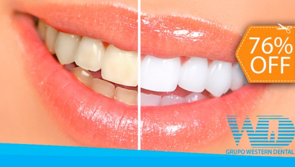 [Image: ¡Paga $79 en vez de $325 por 1 Sesión de Blanqueamiento Dental EXTREMO con sistema ZOOM + Limpieza con Ultrasonido en la Lujosa Sala VIP de Western Dental San Benito!m]