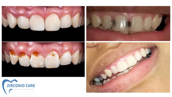 [Image: ¡Paga $25 en Lugar de $210 por Reconstrucción Mínimamente Invasiva de 4 Dientes Frontales + Consulta General + Limpieza Dental + Aplicación Tópica de Flúor + Férula + Estuche!m]