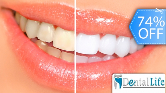 [Image: ¡Paga Q395 en vez de Q1,500 por Blanqueamiento Dental Láser + Limpieza y Pulido Dental con Profilaxis + Eliminación de Sarro con Ultrasonido + Aplicación Tópica de Flúor + Examen Diagnóstico en Dental Life!m]