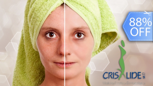 [Image: ¡Paga Q99 en vez de Q850 por Limpieza Facial Clínica con: Peeling Hidratante con Ácido Lactobiónico + Vaporización de Ozono + Extracción de Puntos + Alta Frecuencia + Electroporación con Aceites Personalizados + Mascarilla y más en Crisalide!m]