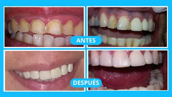 [Image: ¡Logra una sonrisa perfecta! Paga $25 en lugar de $125 por Diseño de Sonrisa con: Carilla Dental de Resina Nano Híbrida de Porcelana y Zirconio!m]