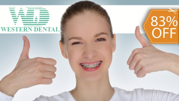 [Image: ¡Paga $99 en lugar de $575 por Colocación de Brackets Metálicos en Western Dental!m]