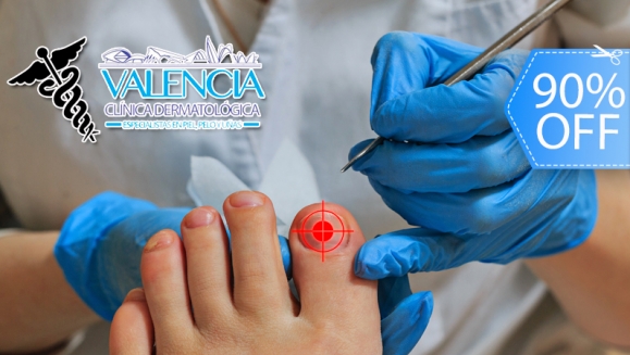 [Image: ¡Elimina los Hongos de las Uñas YA! ¡Paga Q75 en lugar de Q750 por Sesión Láser para Hongos en 1 Uña en Valencia Clínica Dermatológica!m]