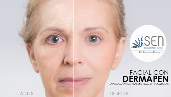 [Image: ¡Paga $75 en Lugar de $150 por 1 Sesión de Dermapen + Plasma Rico en Plaquetas para Rejuvenecimiento del Rostro, Eliminación de Estrías y Cicatrices y/o Evitar la Caída del Cabello!m]