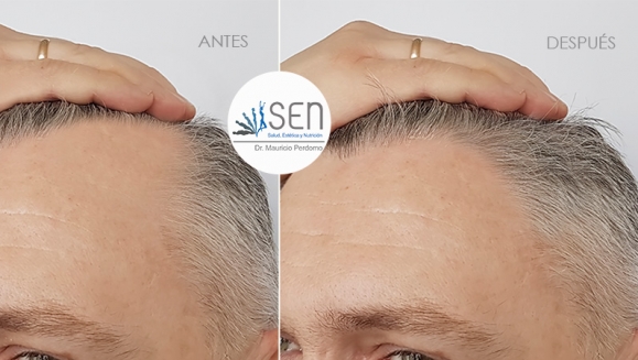 [Image: ¡Paga $75 en Lugar de $150 por 1 Sesión de Dermapen + Plasma Rico en Plaquetas para Rejuvenecimiento del Rostro, Eliminación de Estrías y Cicatrices y/o Evitar la Caída del Cabello!m]