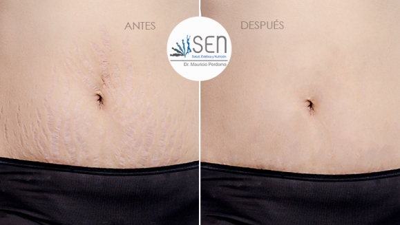 [Image: ¡Paga $75 en Lugar de $150 por 1 Sesión de Dermapen + Plasma Rico en Plaquetas para Rejuvenecimiento del Rostro, Eliminación de Estrías y Cicatrices y/o Evitar la Caída del Cabello!m]