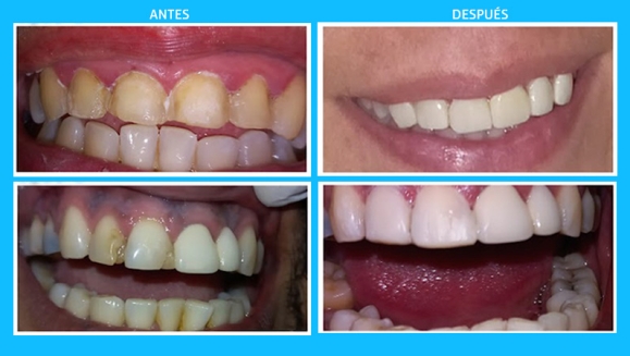 [Image: ¡Recupera Tu Sonrisa Perfecta! ¡Paga $30 en Vez de $125 por Paquete a Elección de Carillas Dentales de Resina Nano Híbrida de Porcelana y Zirconio Entre: A) 1 Carilla + Limpieza + Férula + Estuche, B) 2 Carillas + Limpieza o C) 4 Carillas!m]
