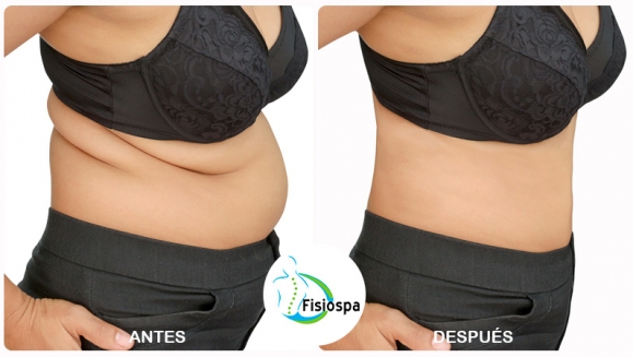[Image: ¡Paga $35 en Lugar de $525 por 18 Tratamientos Reductivos: 3 Mesoterapias + 3 Vacumterapias + 4 Ultracavitaciones + 3 Masajes Reductivos + 2 Masajes Linfáticos + 2 Thermoterapias + 1 Endermoterapia + Evaluación + Dieta Personalizada!m]