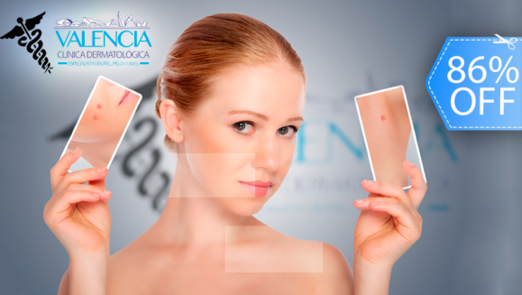[Image: ¡Paga Q195 en vez de Q1,400 por Paquete Facial Anti Acné de 11 Tratamientos que Incluye: 2 Microdermoabrasiones + 1 Peeling + 1 Sesión de Luz LED y Mucho Más en Valencia Clínica Dermatológica!m]