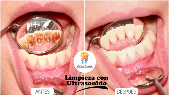 [Image: ¡Paga $9 en Lugar de $70 por Limpieza Dental con Ultrasonido + Pulido + Aplicación de Flúor + Consulta y Diagnóstico + Evaluación Clínica de Cordales!m]