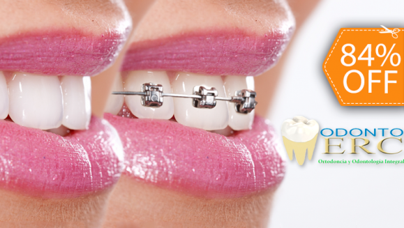 [Image: ¿Quieres tus dientes perfectamente alineados? ¡Paga $90 en lugar de $550 por Colocación de Mini-Brackets Metálicos para Alinear los Dientes en Odontomerc!m]