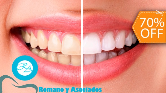 [Image: ¡Paga $70 en vez de $237 por Blanqueamiento Dental con Sistema Zoom + Limpieza con Ultrasonido + Diagnóstico con Cámara Intraoral + Revisión de Cordales en Clínica Médica Romano y Asociados!m]