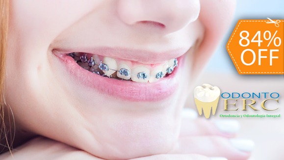 [Image: ¿Quieres una Sonrisa Perfecta? ¡Paga $90 en lugar de $550 por Colocación de Mini-Brackets Metálicos para Alinear los Dientes en Odontomerc!m]
