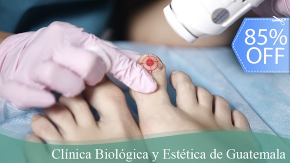 [Image: ¡Paga Q79 en vez de Q520 por Tratamiento Láser contra Hongos para 1 Uña + Laca- Anti Onicomicosis + Evaluación Médica!m]