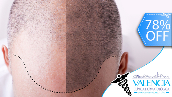 [Image: ¡Libérate de la Pérdida del Cabello! ¡Paga Q799 en lugar de Q3,600 por Tratamiento contra Alopecia (Calvicie) que Incluye: 1 Sesión de Plasma Rico en Plaquetas + 3 Sesiones de Carboxiterapia + 3 Sesiones de Luz LED!m]