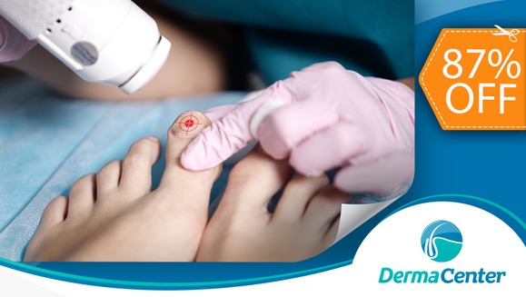 [Image: ¡Paga $39 en lugar de $300 por Tratamiento Láser para 2 Uñas con Hongos + Evaluación Previa con Dermatólogo!m]