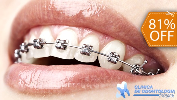 [Image: ¡Paga $85 en lugar de $450 por Colocación de Mini-Brackets Metálicos + Evaluación y Diagnóstico de Ortodoncia + Diagnóstico Odontológico General + Profilaxis Dental!m]
