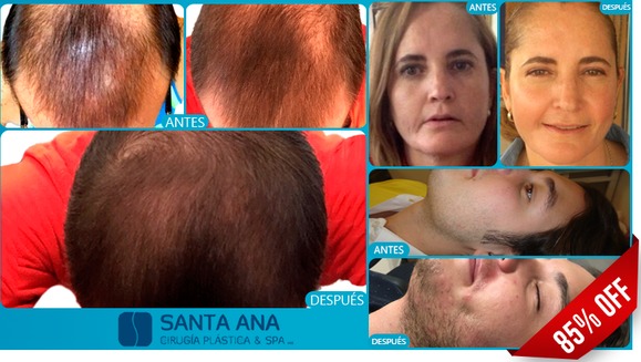 [Image: ¡Paga $200 en lugar de $1,350 por 3 Sesiones de Plasma Rico en Plaquetas con Factores de Crecimiento para Estimulación del Vello Facial o Capilar o para Rejuvenecimiento de Rostro!m]