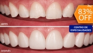 [Image: ¡Paga $40 en Lugar de $230 por Reconstrucción Estética con Resina de 4 Dientes Frontales + Consulta General + Revisión de Cordales + Limpieza Dental + Aplicación Tópica de Flúor!m]