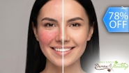 [Image: ¡Recupera la Confianza en tu Piel! ¡Paga Q195 en Lugar de Q900 por 2 Sesiones de Tratamiento para la Rosácea en Rostro: Evaluación Profesional + Fototerapia LED + Alta Frecuencia + Iontoforesis por Oclusión con Velo de Colágeno + Mascarillas y Más!m]